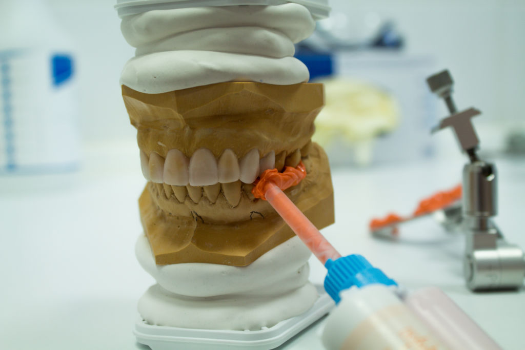 Modelle mit Bissregistrat - Zahnästhetik Berlin