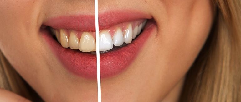 Schöne Zähne – strahlendweiß ein schönes Lächeln